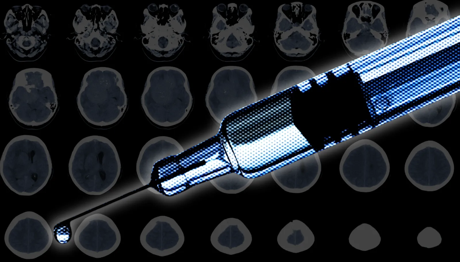 Contraception and Meningiomas: What To Know